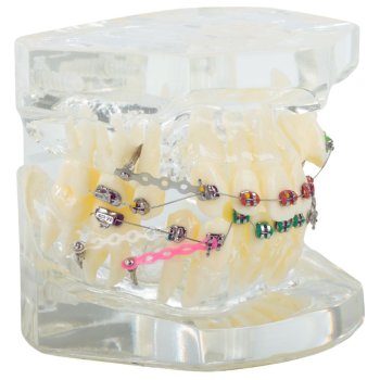 Dental Jaw Model with Orthodontic Braces, 6.5x6.5x7.5 cm