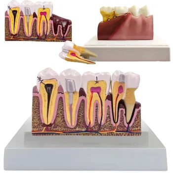 Anatomical Tooth Model with Pathologies, Removable Tooth