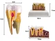 Anatomical Tooth Model with Pathologies, Removable Tooth